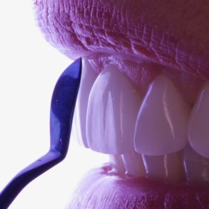 shaping tool near tooth 