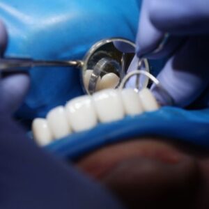dentist uses mirror to check behind teeth 