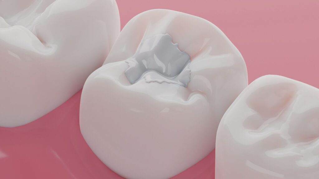 dental composite