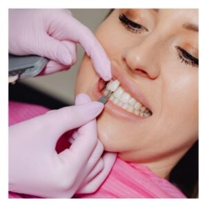 matching tooth color to dental composite